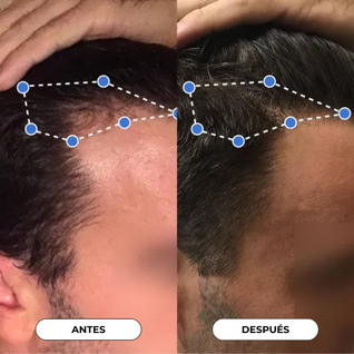 Suero en Roll - On para el crecimiento del cabello