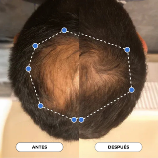 Suero en Roll - On para el crecimiento del cabello